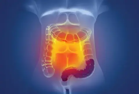 Optimizing bowel prep for inpatient colonoscopy: 