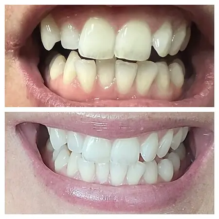 Before and After of one whitening session