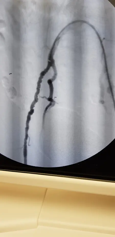 Fibromuscular displacia on a female patient treated with angioplasty in the pelvic area